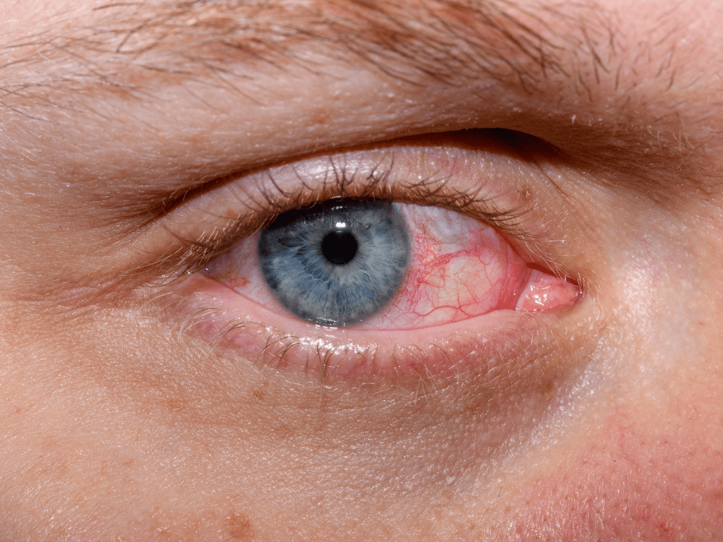 How do you make an eye sting go away? - Dermii